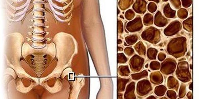 osteoporose Osteoporose